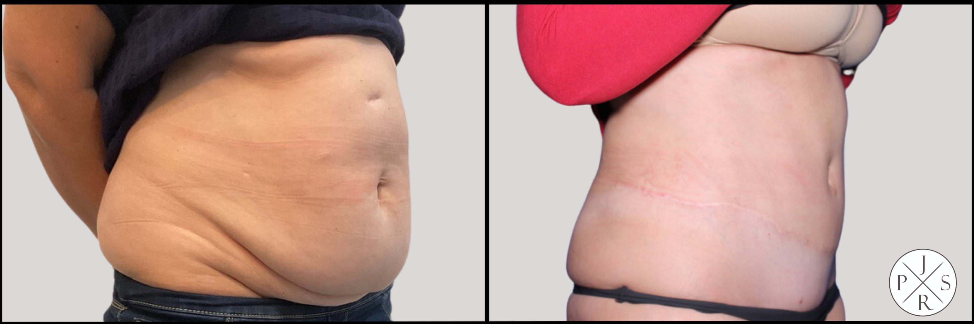 Abdominoplasty Before & After Image